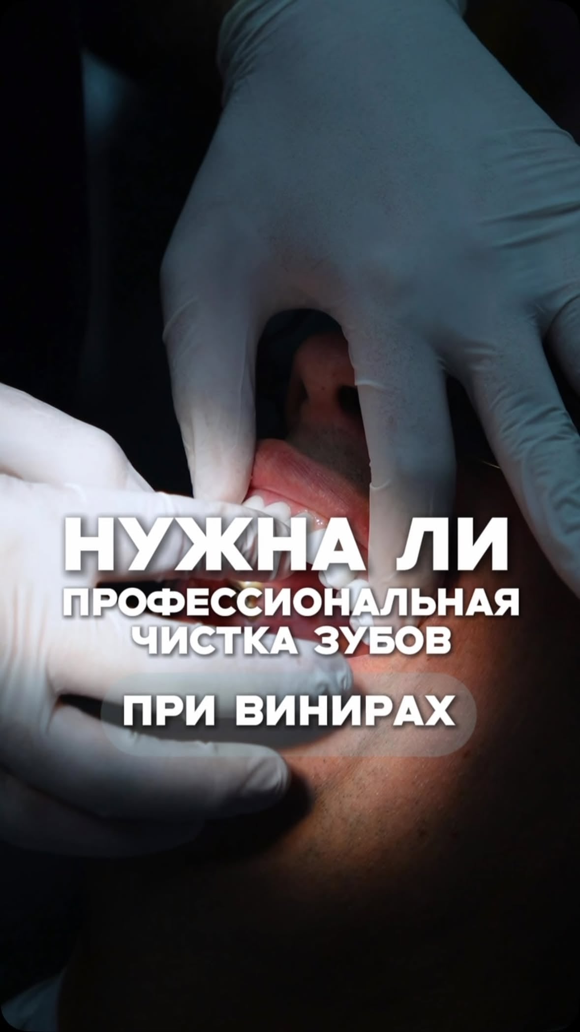 Профгигиена и виниры
